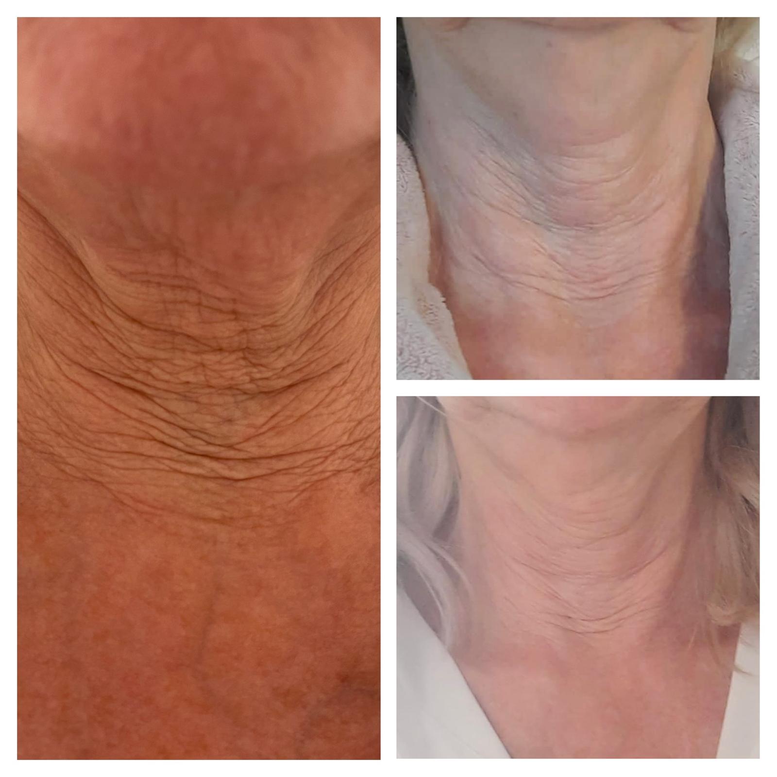 Biostimulatoren — behandelresultaat