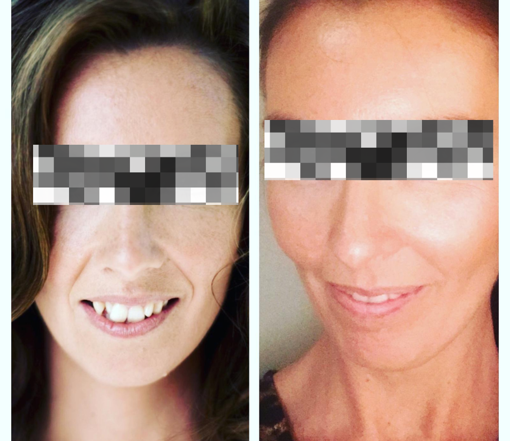 Essential Glow — behandelresultaat