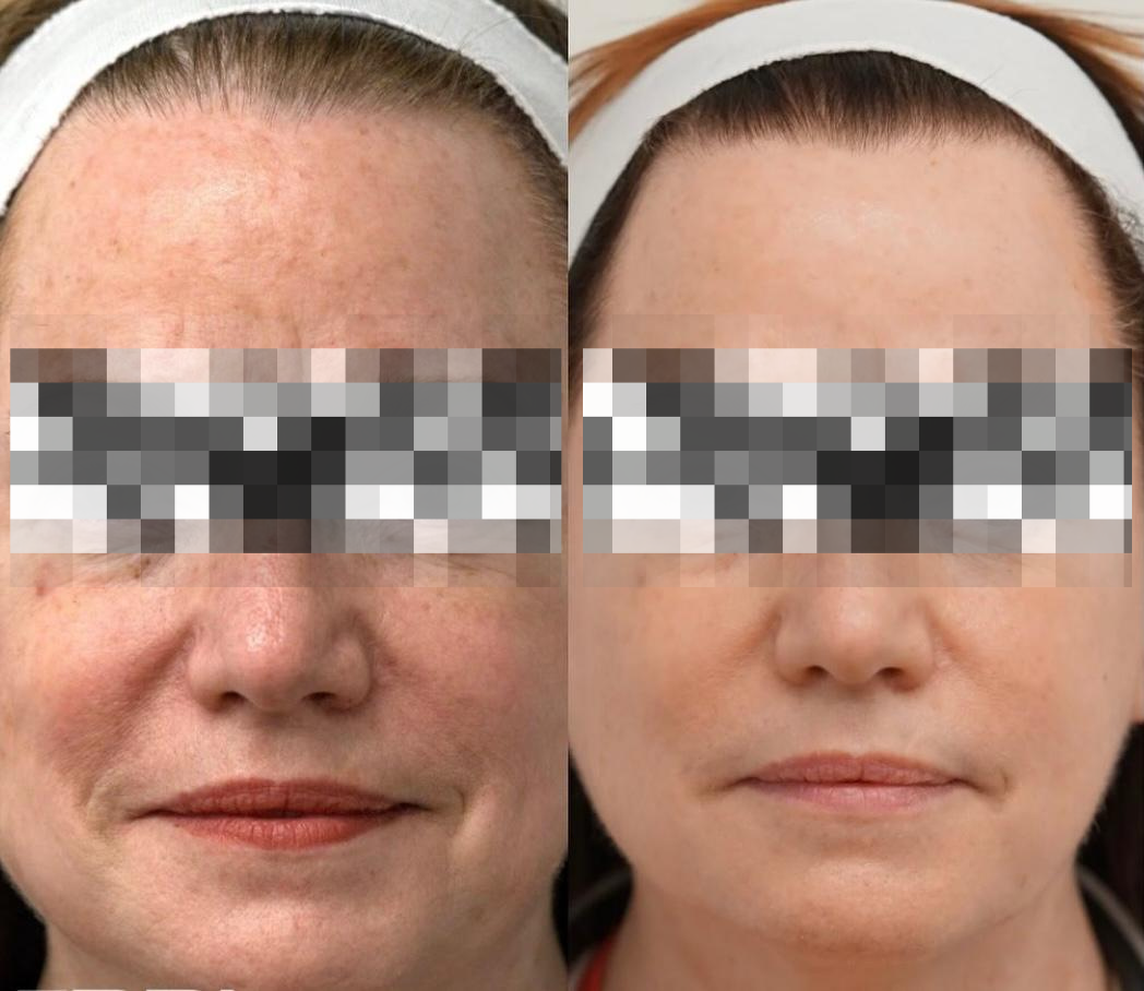 Essential Glow — behandelresultaat